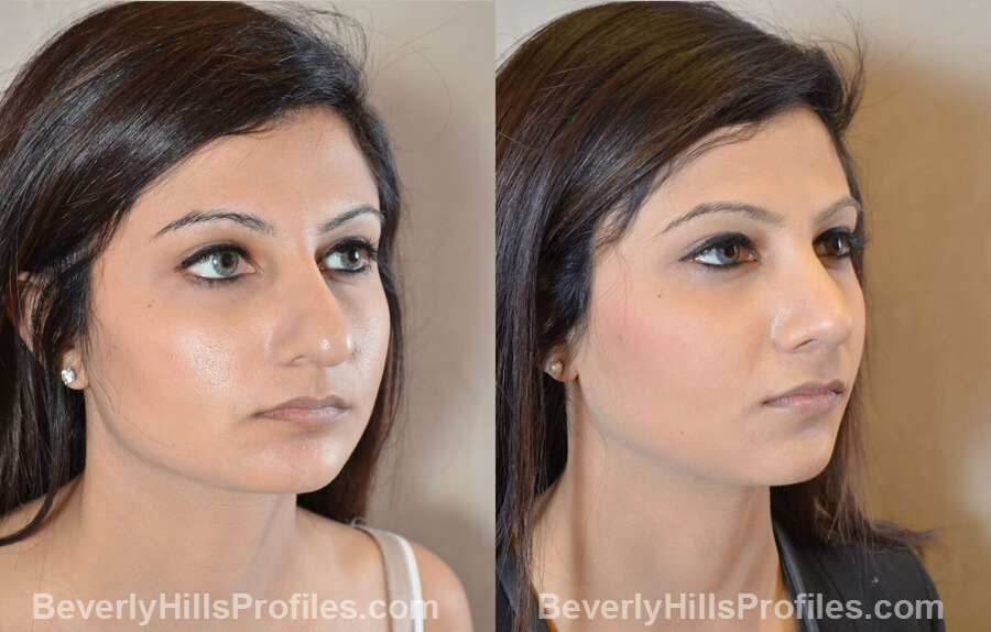 images Female patient before and after Nose Surgery Procedures - oblique view