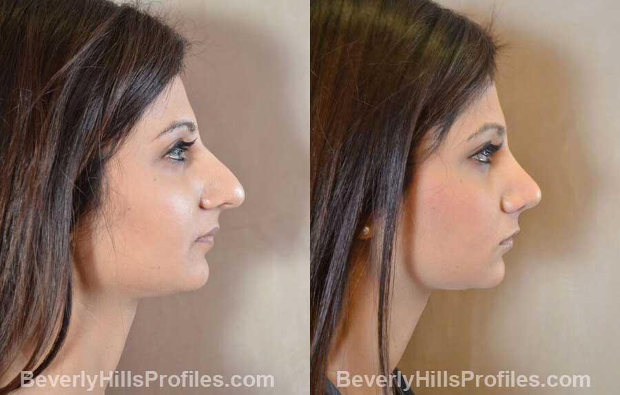 images Female patient before and after Nose Surgery Procedures - right side view