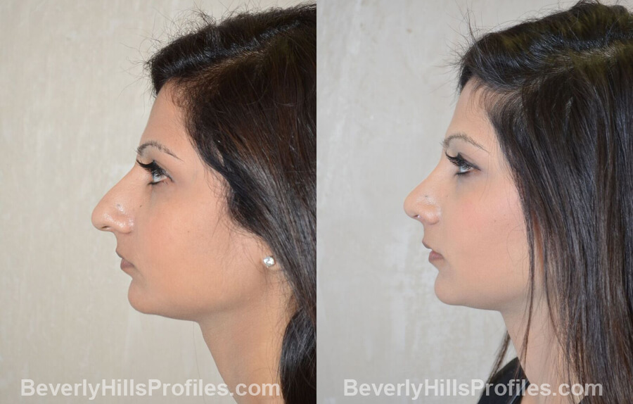images Female patient before and after Nose Surgery Procedures - left side view