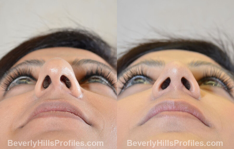 images Female patient before and after Nose Surgery Procedures - underside view