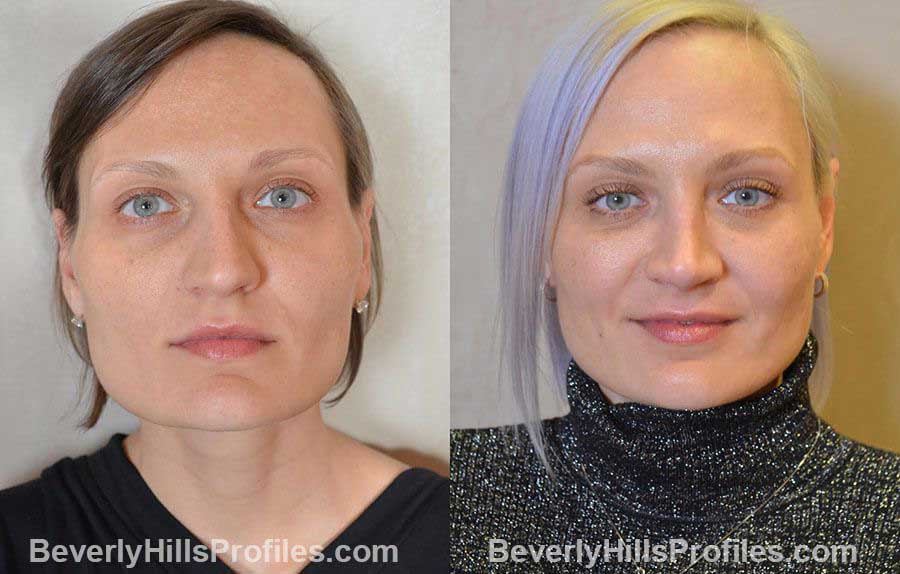 Female patient before and after Nose Surgery Procedures - front view