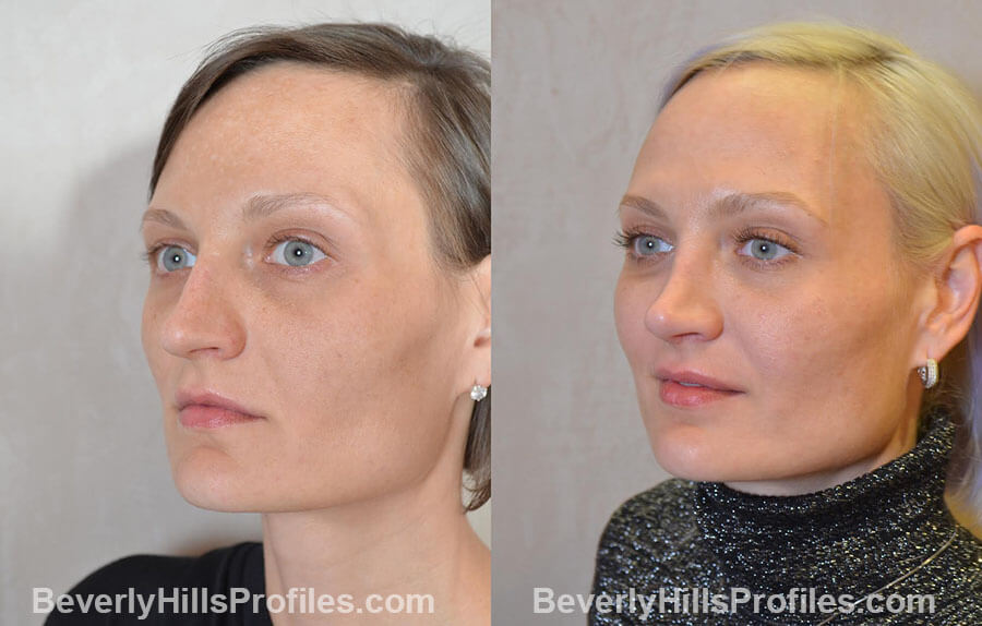 Female patient before and after Nose Surgery Procedures - left oblique view