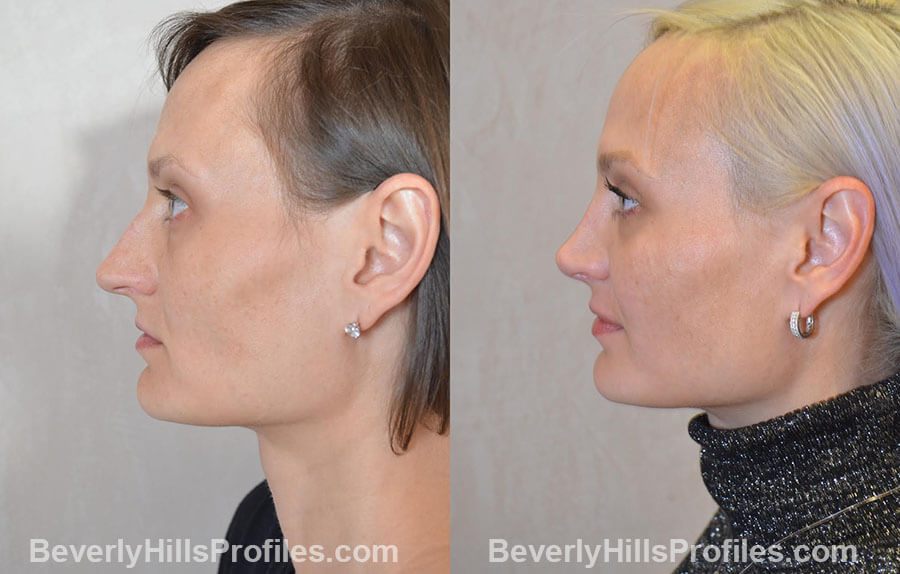 Female patient before and after Nose Surgery Procedures - left side view