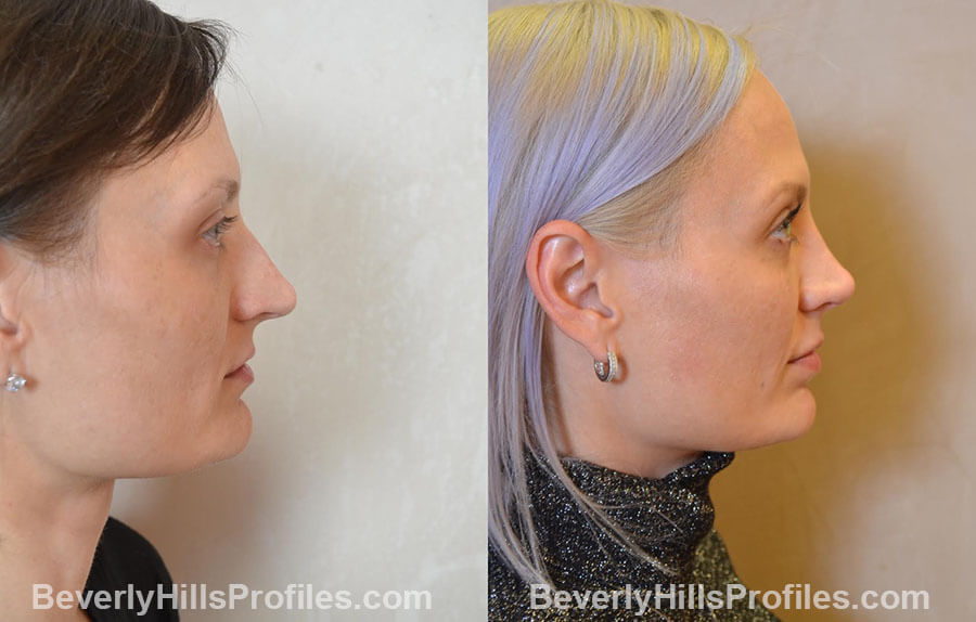 Female patient before and after Nose Surgery Procedures - right side view
