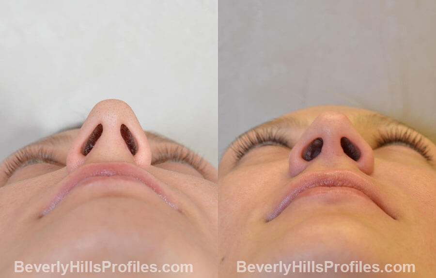 Female patient before and after Nose Surgery Procedures - underside view