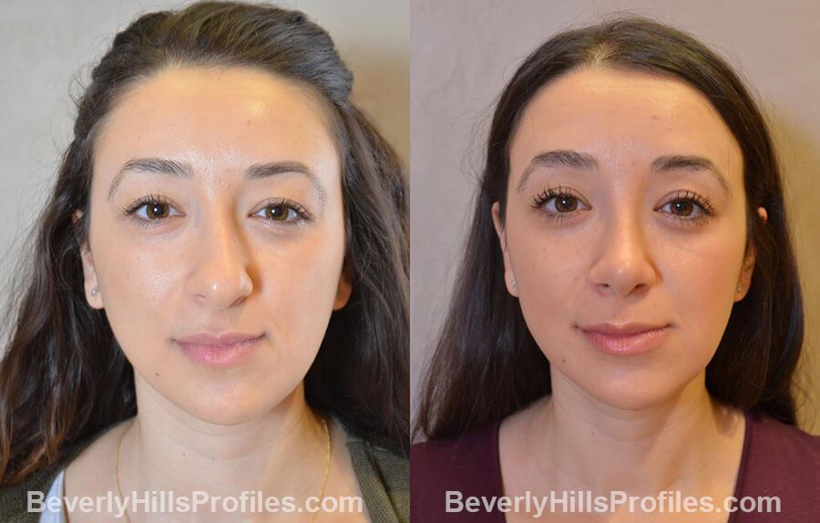 patient before and after Nose Surgery Procedures - front view