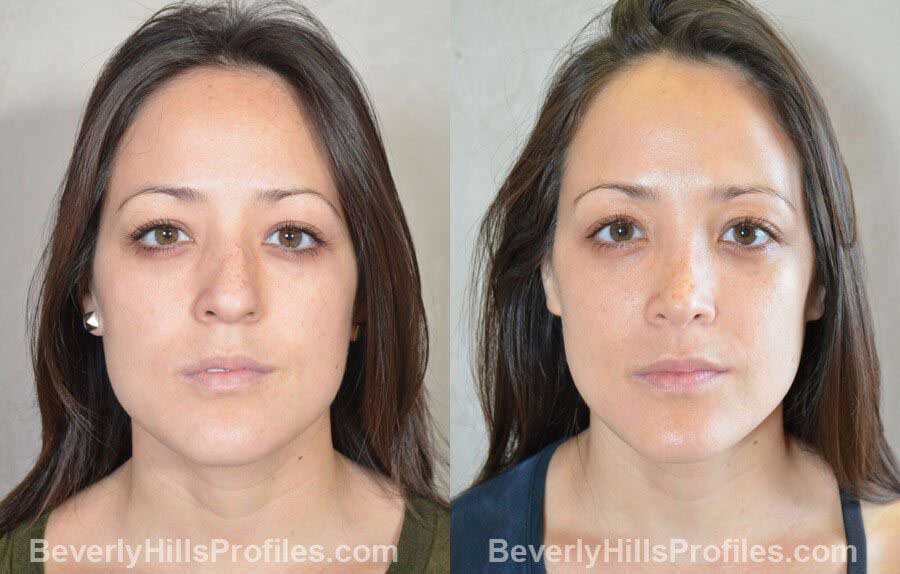 imgs Female patient before and after Nose Surgery Procedures, front view