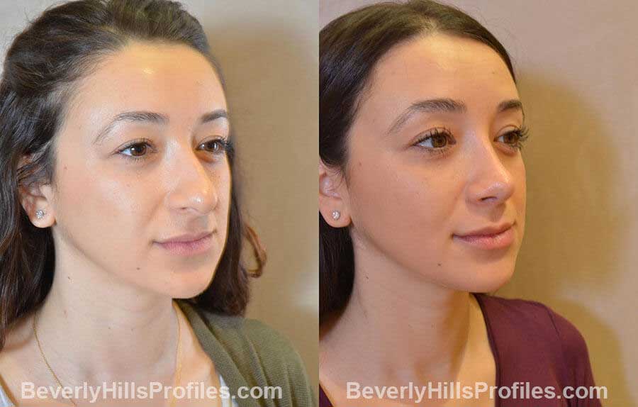 patient before and after Nose Surgery Procedures - oblique view