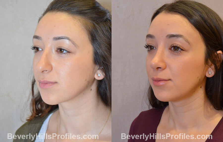 patient before and after Nose Surgery Procedures - left oblique view