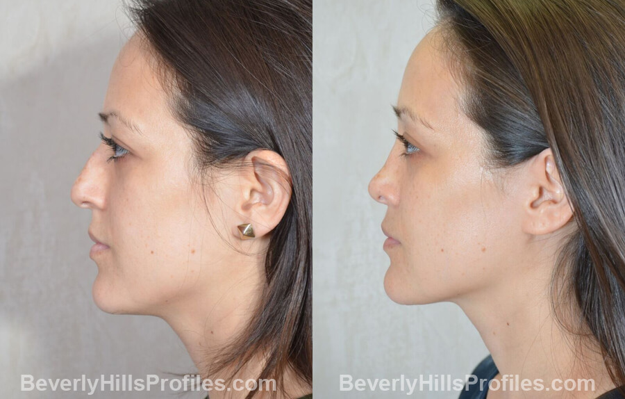 imgs Female patient before and after Nose Surgery Procedures, side view