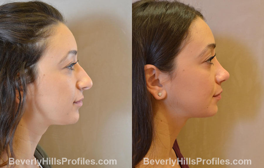 patient before and after Nose Surgery Procedures - left side view