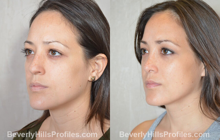 imgs Female patient before and after Nose Surgery Procedures, left oblique view