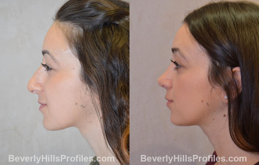 patient before and after Nose Surgery Procedures - right side view