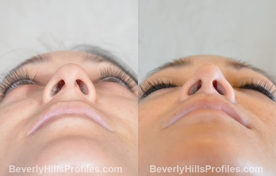 imgs Female patient before and after Nose Surgery Procedures, underside view