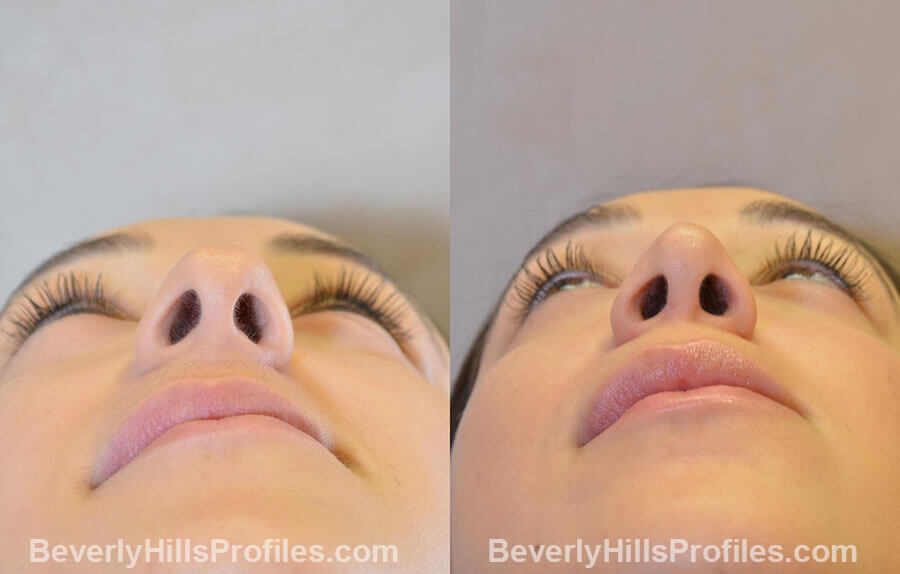 patient before and after Nose Surgery Procedures - underside view