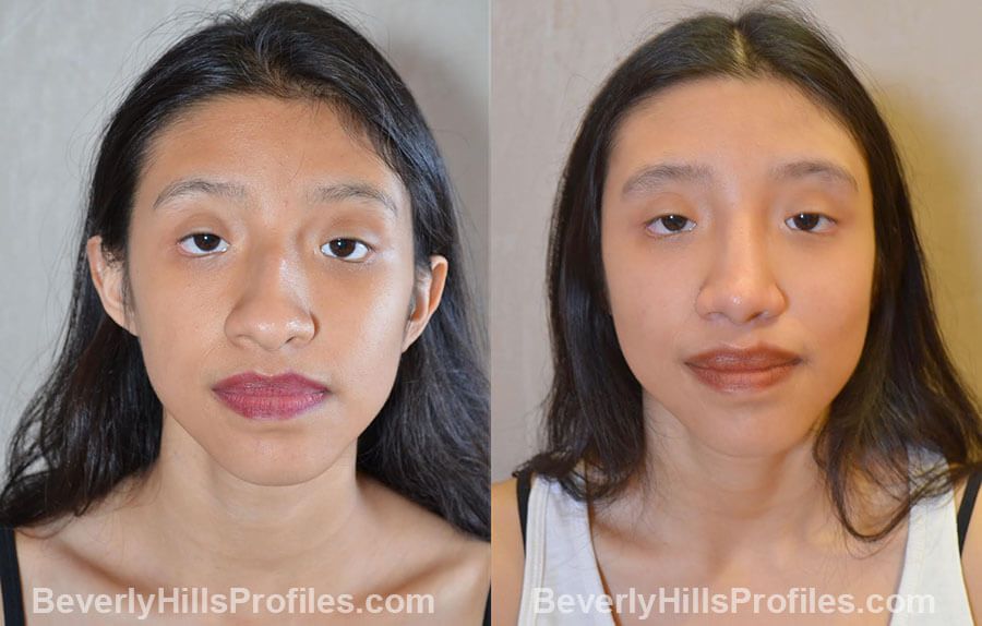before and after Nose Surgery Procedures - front view