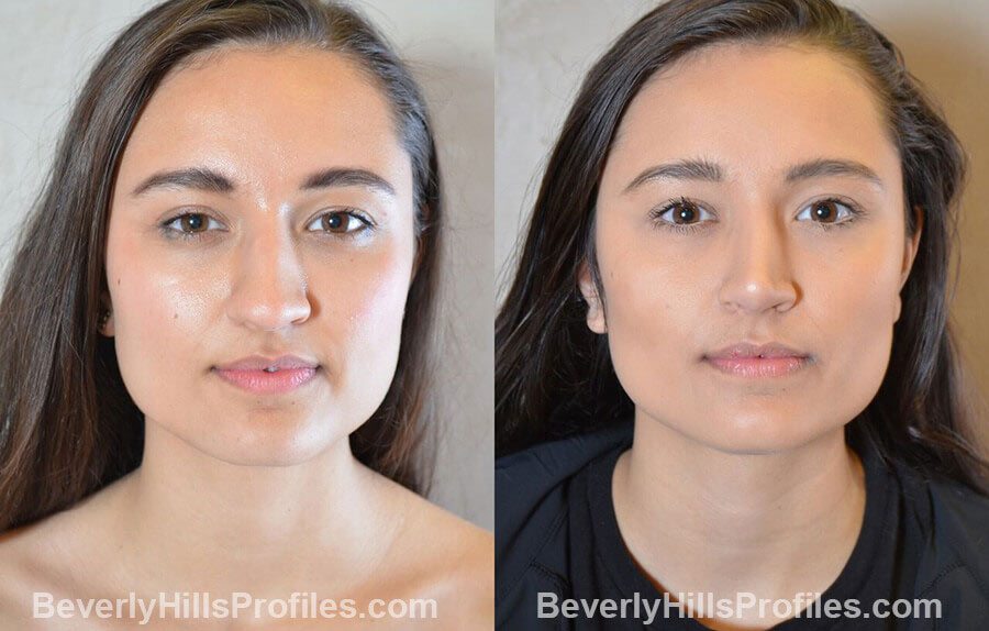 pics Female patient before and after Nose Surgery Procedures front view