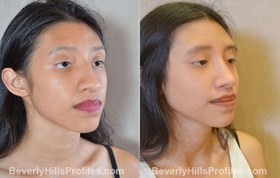 before and after Nose Surgery Procedures - oblique view