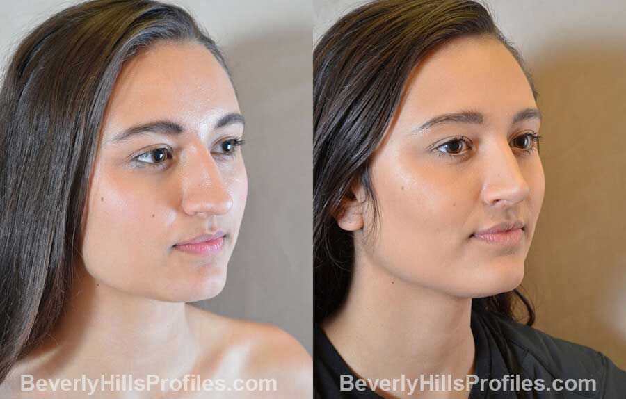 nose job before and after female front view