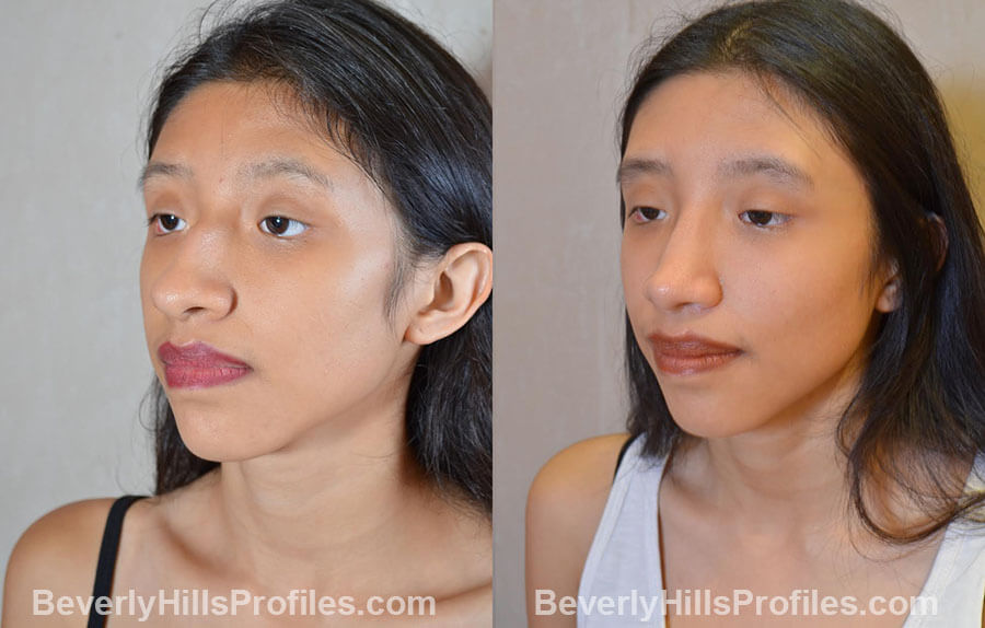 before and after Nose Surgery Procedures - left oblique view