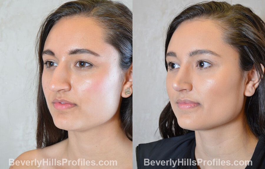 pics Female patient before and after Nose Surgery Procedures left oblique view