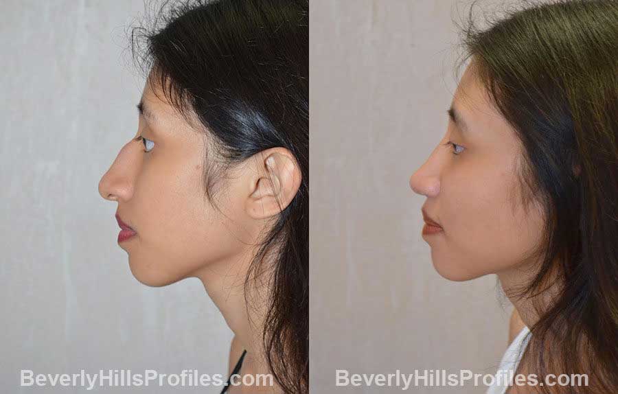 before and after Nose Surgery Procedures - left side view