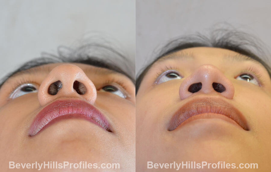 before and after Nose Surgery Procedures - underside view