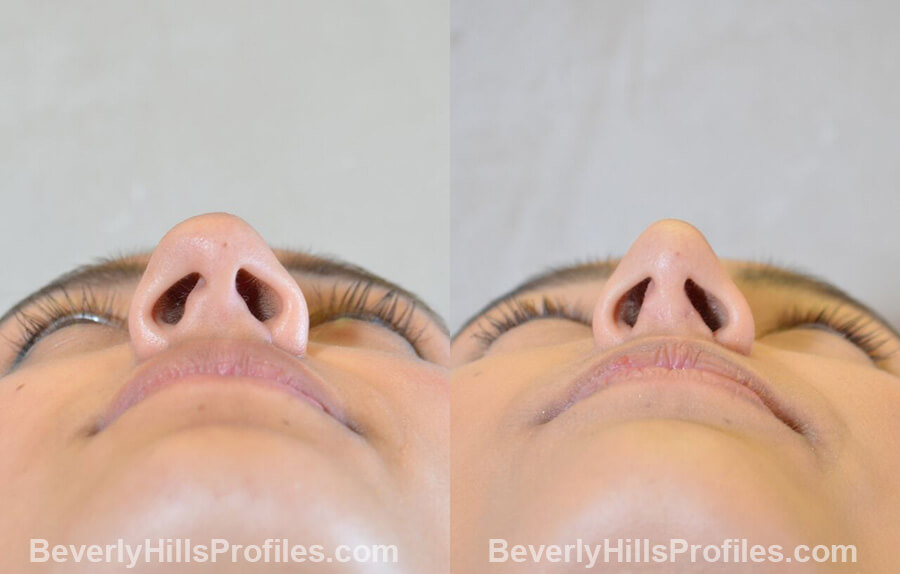 pics Female patient before and after Nose Surgery Procedures underside view
