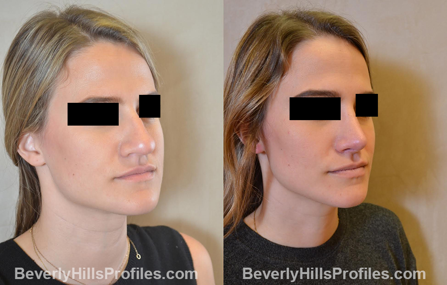 before and after Nose Surgery - oblique view