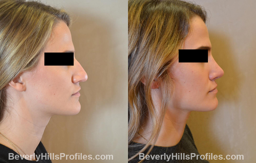 before and after Nose Surgery - right side view