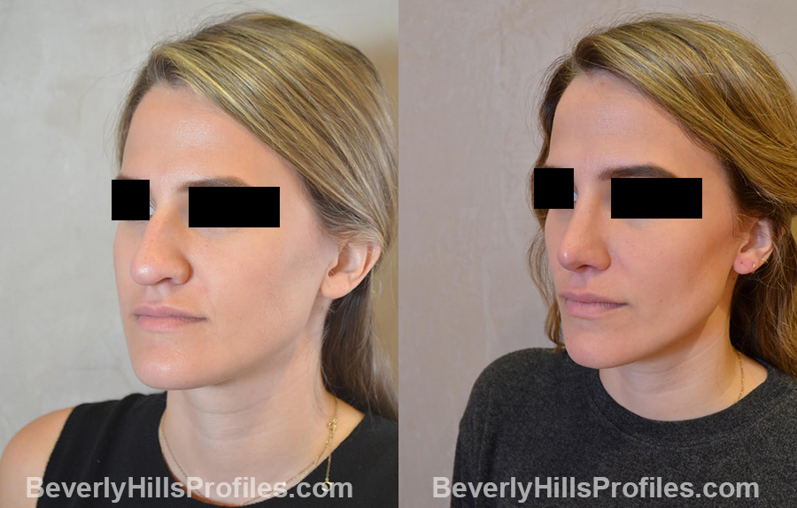before and after Nose Surgery - left oblique view