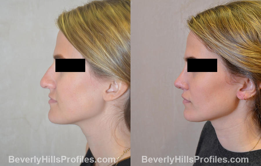 before and after Nose Surgery - left side view