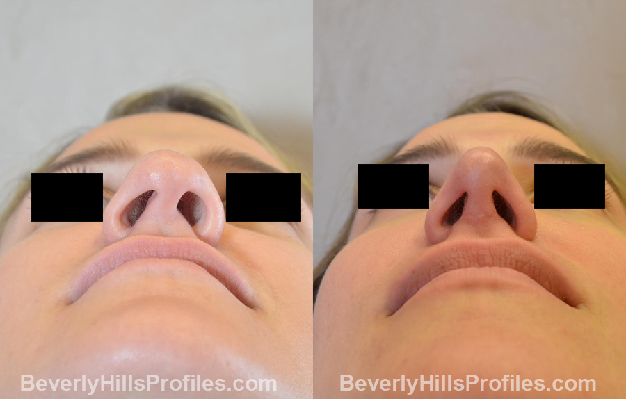 before and after Nose Surgery - underside view