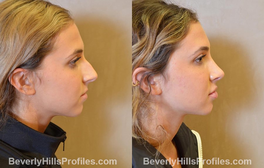 photos before and after Nose Job - right side view