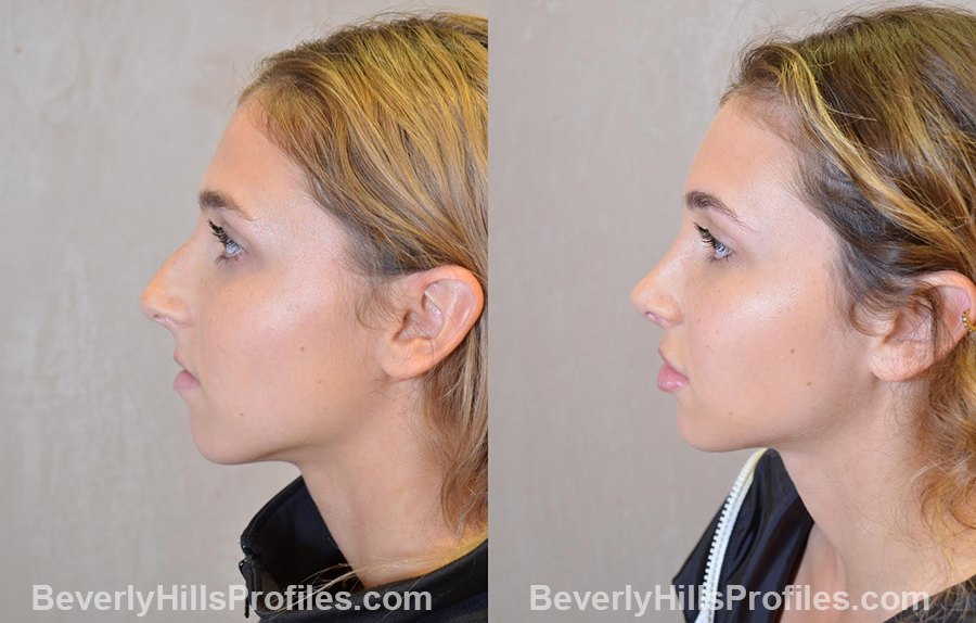 photos before and after Nose Job - left side view