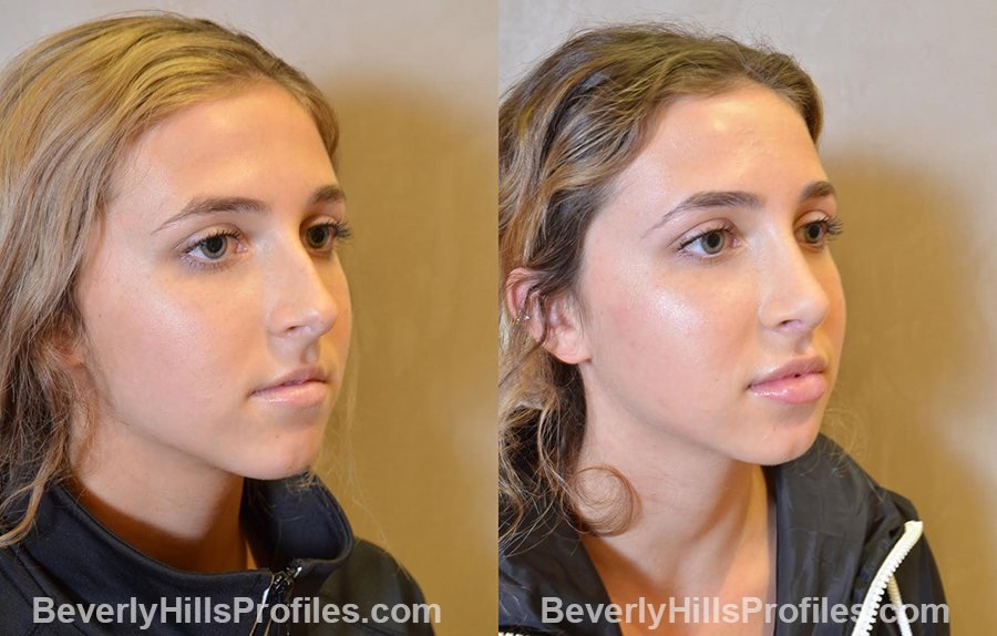 before and after Nose Job - photos