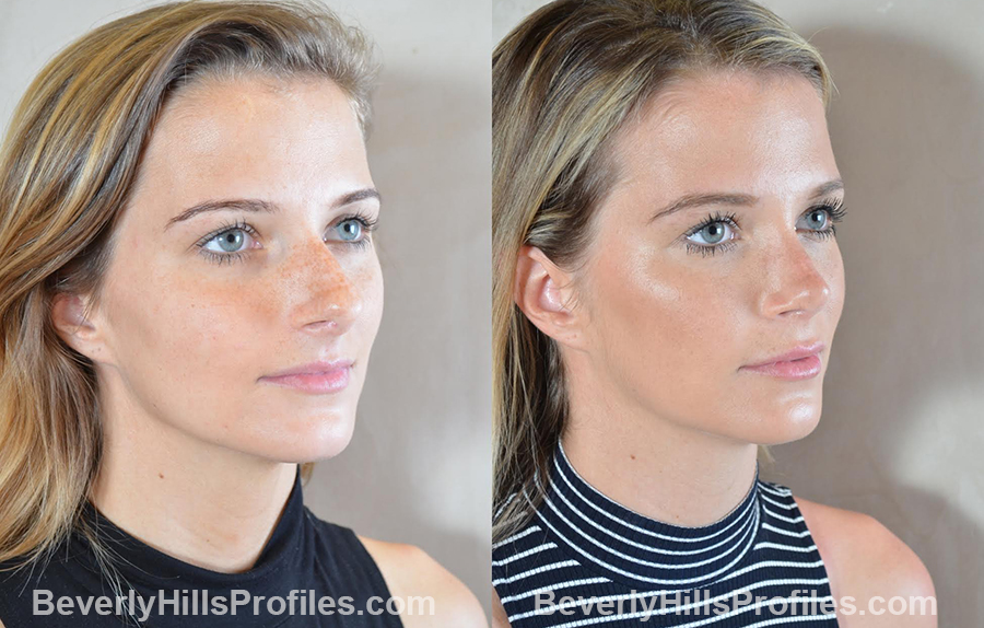 photos before and after Nose Surgery Procedures - oblique view
