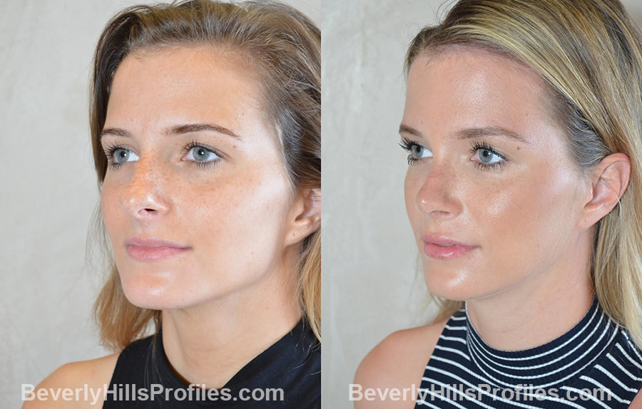 Rhinoplasty Before and After - female, oblique view