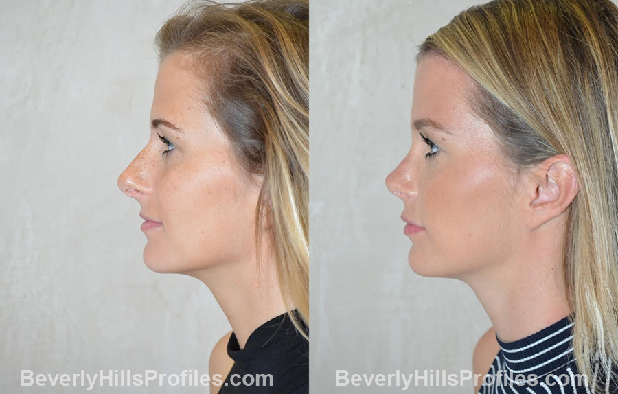 photos before and after Nose Surgery Procedures - left side view