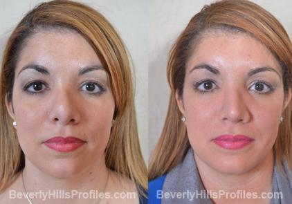 Revision Rhinoplasty Before and After Photo Gallery - front view, female patient 24