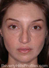 Female face - after Nasal Anatomy treatment, front view
