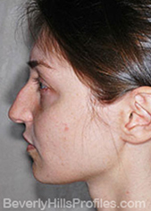 Female face - before Nasal Anatomy treatment, left side view