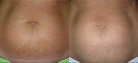 Female tummy, before and after Stretch marks treatment, front view