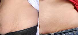 Female tummy, before and after Stretch marks treatment, patient 2, oblique view