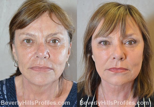 Facelift Before and After Photo Gallery - female, front view, patient 11