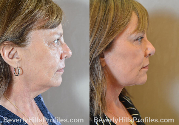 Facelift Before and After Photo - male, profile view
