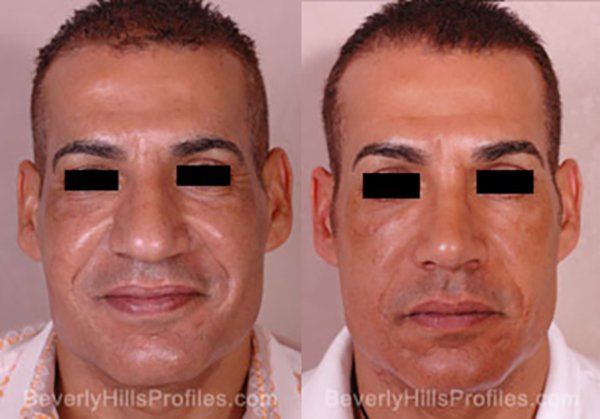 Facelift Before & After Photo Gallery