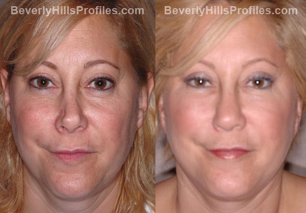 Facelift Before and After Photo Gallery - female, front view, patient 9