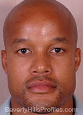 AFRICAN AMERICAN RHINOPLASTY - After Treatment Photo: male front view, patient 2