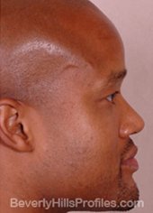 AFRICAN AMERICAN RHINOPLASTY - After Treatment Photo: male right side view, patient 2